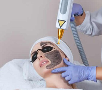 Carbon Peel